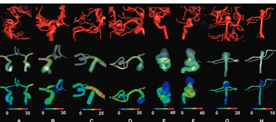 Fig 1. Schematic representations of regions for hemodynamic data analysis.C A, Regions in the arteries of terminal or bifurcation aneurysms