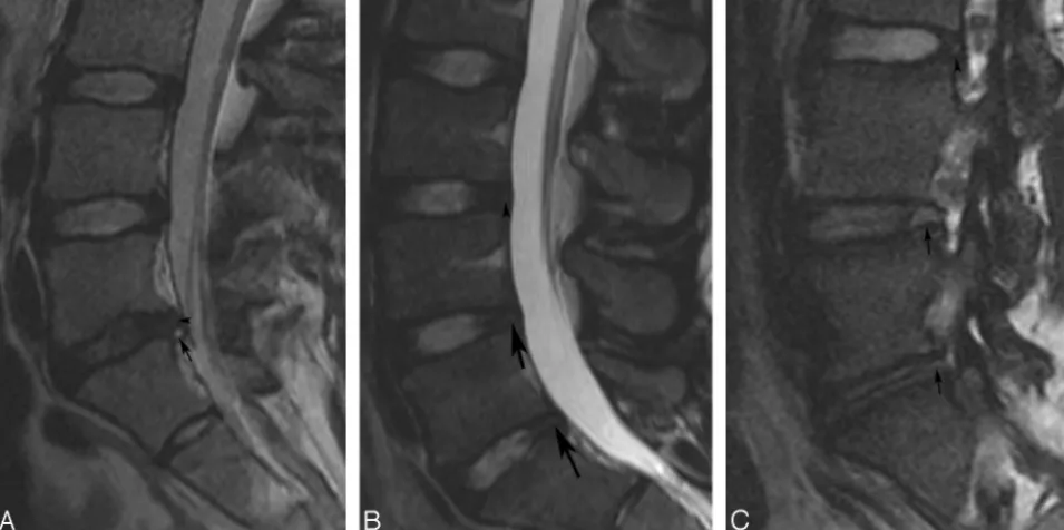 Fig 1. Examples of nuclear degeneration and annular tears.a grade 2 radial tear at L5–S1 (or 2 (L5-S1) and a degeneration grade of 2.The tear is considered radial based on less conspicuous intermediate signal intensity extending across almost the entire th