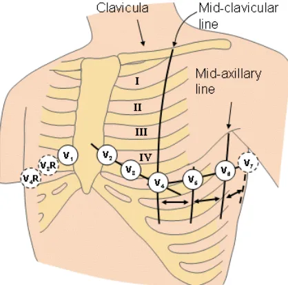 Figure 1-1. Illustration of precordial lead placement on a human subject.5 