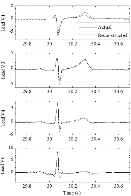 Figure 3-1 Comparisons of actual precordial leads and those reconstructed from the ICs precordial leads to the mean of the database at 30 seconds after the training periodof leads V2 and V5