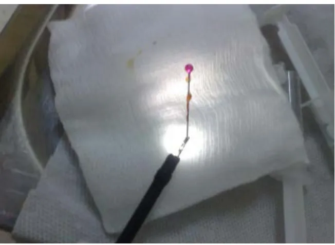 Figure 3. Removal of the pin by grasping its proximal end using the forceps. The re-moved headscarf pin is shown