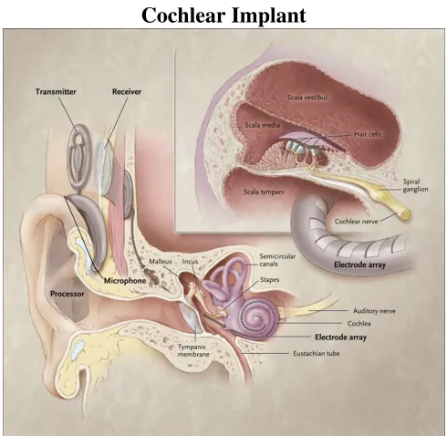 Figure 2.3: Diagram of an Installed Cochlear Implant Device [18].