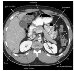 Fig.  1: A CT of a normal abdominal abdomen 