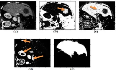 Fig. 2. Liver and Lesion detection: (a) Original CT image; (b) Lesion  highlighted; (c) Liver highlighted; (d) Other organs highlighted; (e) Liver mask