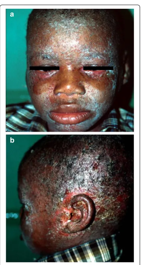 Figure 1 A typical patient with IDH showing exudativedermatitis with crusting on the face, scalp, external ear, andretro-auricular areas