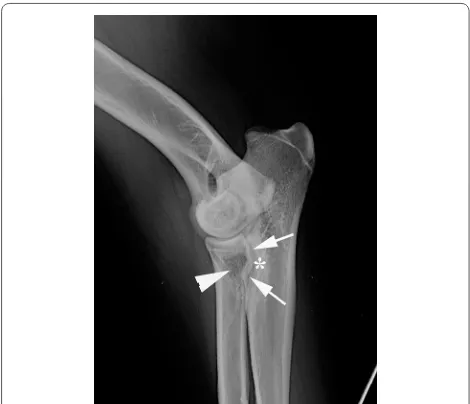 Fig. 1 Extended medio-lateral radiographic view of the right elbow. An abnormal shape of the MCP is visible with a more steep to convex delineation (arrows)