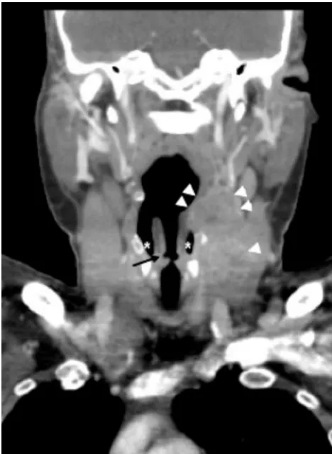 Fig 4. A 48-year-old man with squamous cell carcinoma of the supraglottic larynx. CT wasdelineated (acquired during “eee” phonation