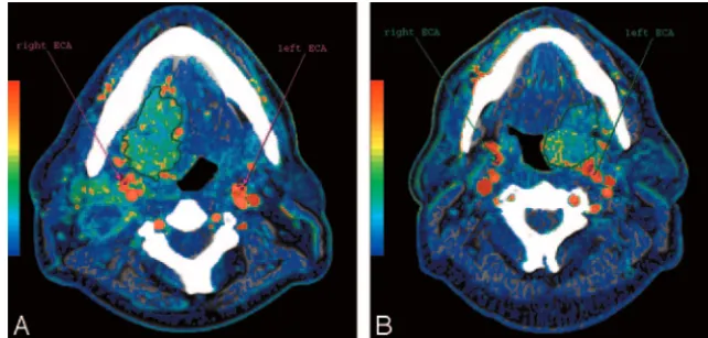 Fig 1. Functional maps of BF from 2 patients with oropharynx SCCA showing the BF calculated in each pixel of the image in a color scale; in the same figure are also shown the arterialinputs obtained from standardized 4-pixel regions of interest placed in t