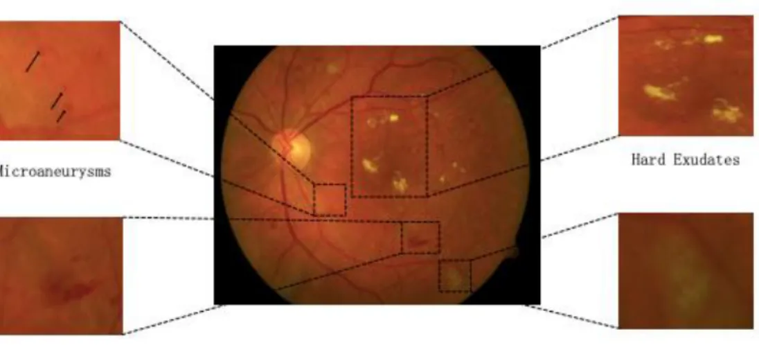 Figure 1. Annotated diabetic retinopathy image showing lesions. 