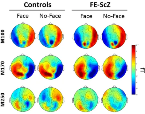 Figure 2.Corresponding ERF traces for all sensors and all trials. Black, Face condition; red, no-face condition.