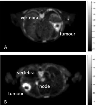Figure 12:  Axial section of summed (last six phases) PET imaging data of patient n.6 (A) and patient n.3 (B)  showing high uptake of D4-Choline in tumour, node and vertebra