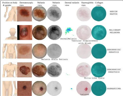 Figure 1 Example SIAscans, with labelled features, of a) benign naevus b) malignant melanoma c) seborrhoeic keratosis d)haemangioma.