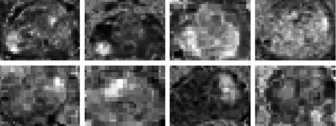 Figure 2.3: Sample computed high-b diffusion weighted images (computed using Eq. 2.7) from eight different patients.