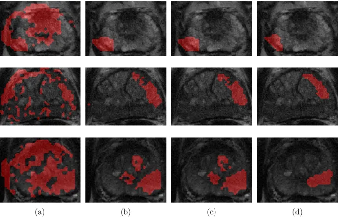 Figure 3.2: Visual comparison of identified suspicious regions (shown in red) between (a) ADC-based method [1], (b) TD using four texture atoms, (c) TD using six texture atoms, and (d) radiologist segmented regions.