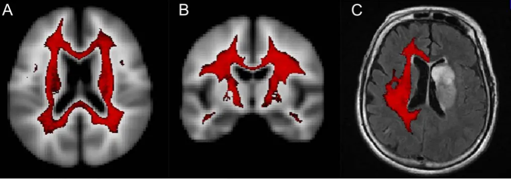 Figure 1 NAWM segmentation. (A) Axial and (B) coronal views of probabilistic white matter mask with threshold of >95% probability white matter (red) superimposed on the International Consortium for Brain Mapping 425 atlas