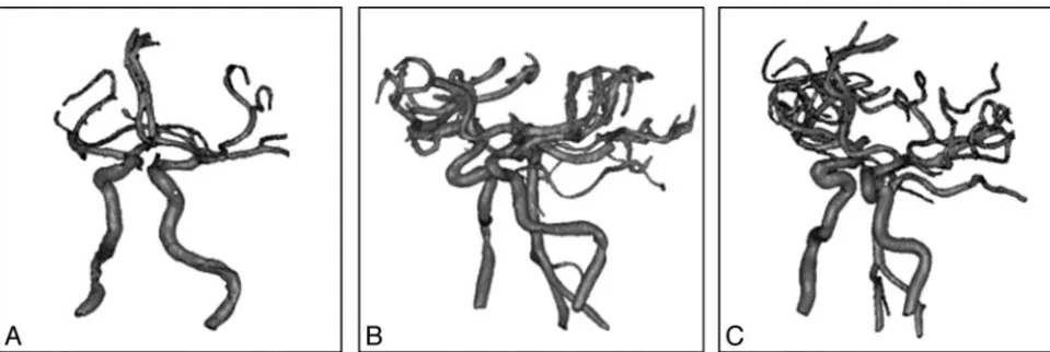 Fig 1. Virtual cerebrovascular models show ICA siphons with mild (A), medium (B), and severe (C) curvature.