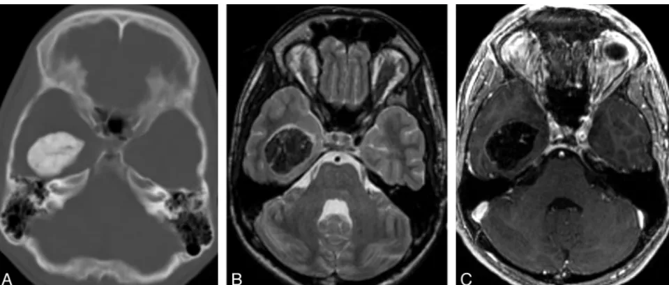 Fig 1. Typical radiologic features of extra-axial CAPNON.uniform T2 hypointense mass centered in the right temporal horn.enhancement that correspond to the strands of T2 hyperintensity