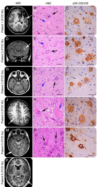 Figure 3Imaging, histopathology, and mTORC1 pathway activity of patients with focal cortical dysplasia