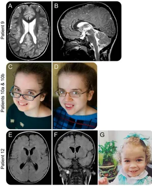 Figure 4Unspecific MRI findings and facial dysmorphy in patients with