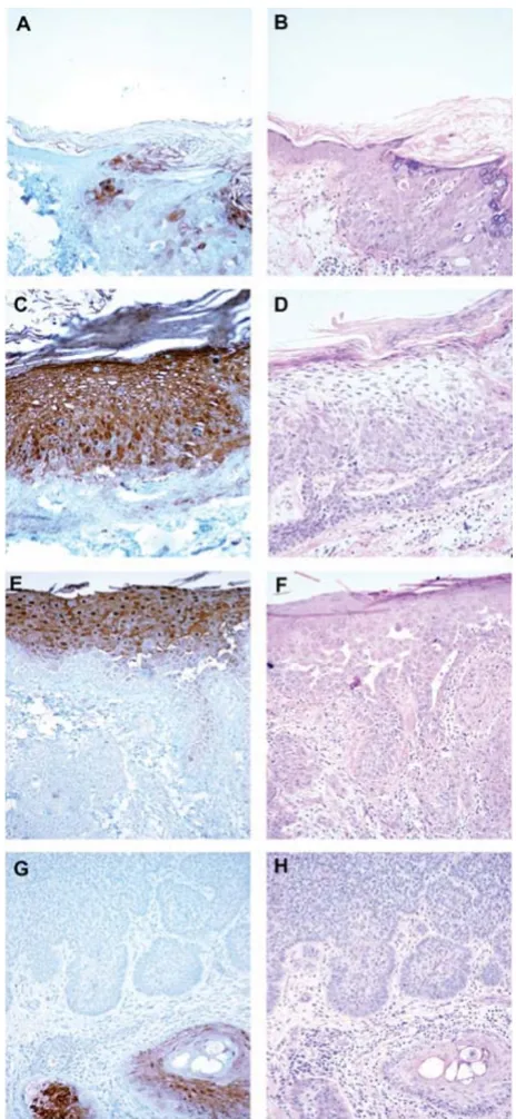 Figure 2Immunohistochemical detection of psoriasin in skin Pattern of psoriasin expression in pre-neoplastic and neo-plastic skin lesions detected by immunohistochemistry (pan-els A,C,E,F) with corresponding areas from H&E stains (panels B,D,F,H)
