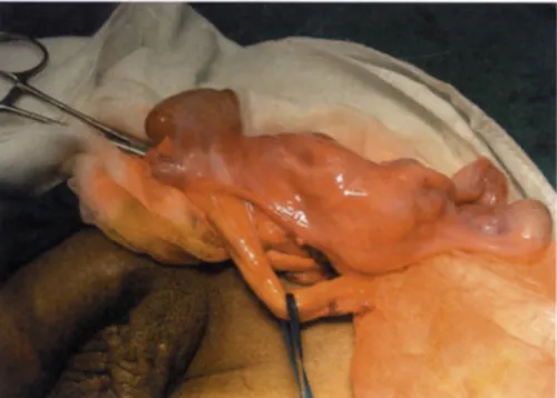 Figure 1 : Prdsence de deux testicules ~ gauche avec une masse mddiane rappelant un utdrus