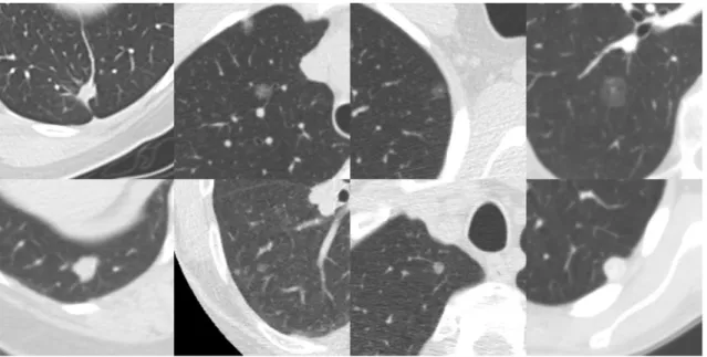 Fig. 3 Eight randomly chosen examples of false negatives of Herakles. Each image shows a transverse field of view of 60 x 60 mm in which the nodule is centred