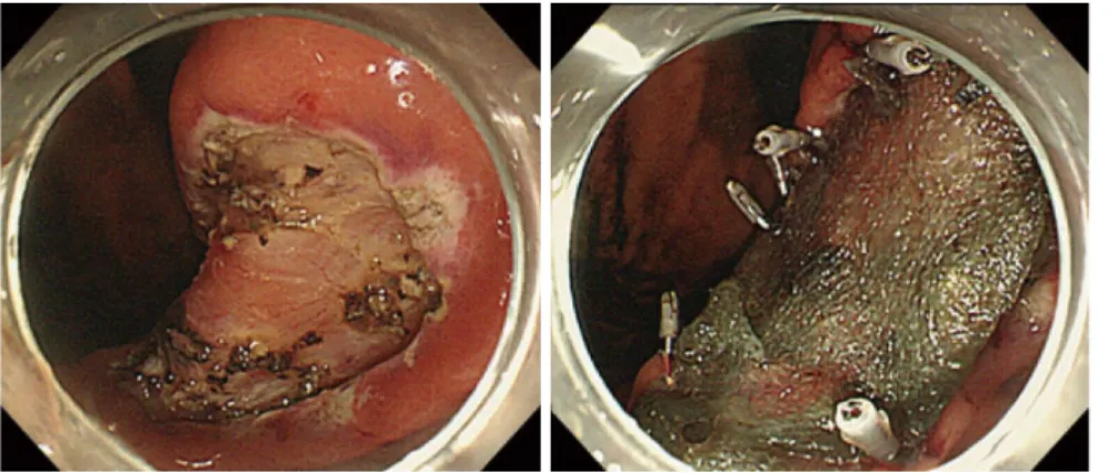 Figure 2  Polyglycolic acid sheets with fibrin glue was applied to the artificial ulcer after gastric endoscopic submucosal dissection by clip and pull  method [82] .