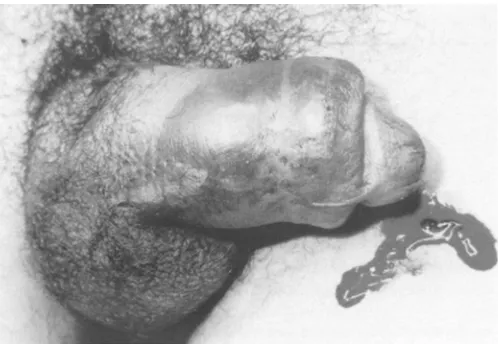 Figure 1 : H~matome de la verge et du scrotum avec incurvation gauche de la verge avec uretrorragie