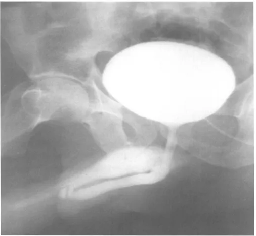 Figure 2 : Ur~trocystographie antdgrade et mictionnelle chez un patient admis pour fracture de la verge : Idsion de la partie moyenne de I'uretre pdnien