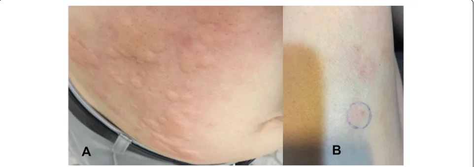 Fig. 1 Allergic reactions to insulin. Before admission, the allergic reaction to insulin was characterized by urticaria with wheals (some of which arereaction to insulin presents with an erythaema and swelling at the injection siteconfluent) and flares (er