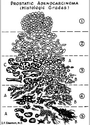 Figure 1.6: Schematic representation of the different Gleason grades assigned to histologic patterns of prostatic adenocarcinoma