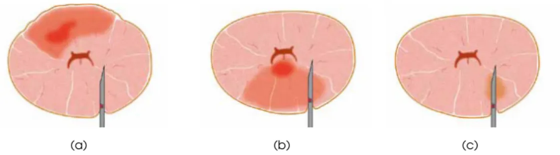 Figure 1.7: Cross sections of the prostate showing the limitations of TRUS guided biopsy