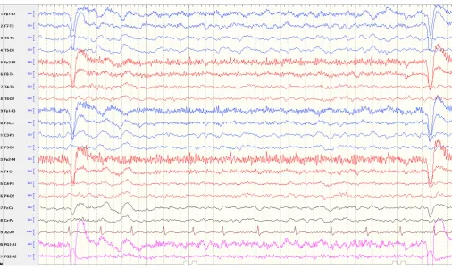 Figure 3 Lateralised intermittent rhythmic delta activity. The electroencephalogram (EEG) showed left side (mainly left temporal lobe) brief intermittent runs of rhythmic delta activity at 1–1.5 Hz