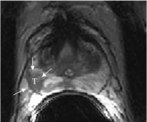 Figure 1. Normal prostate in a 28-year-old man. T2-weigthed  MR image shows peripheral zone (PZ) with intermediate to  high signal intensity
