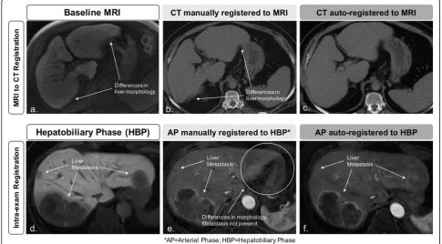 Table 1ter-series time intervals, image artifacts, and inter-seriesvoxel volume differences on liver overlap achieved by au-tomated registration with a binary mask in the internaldataset