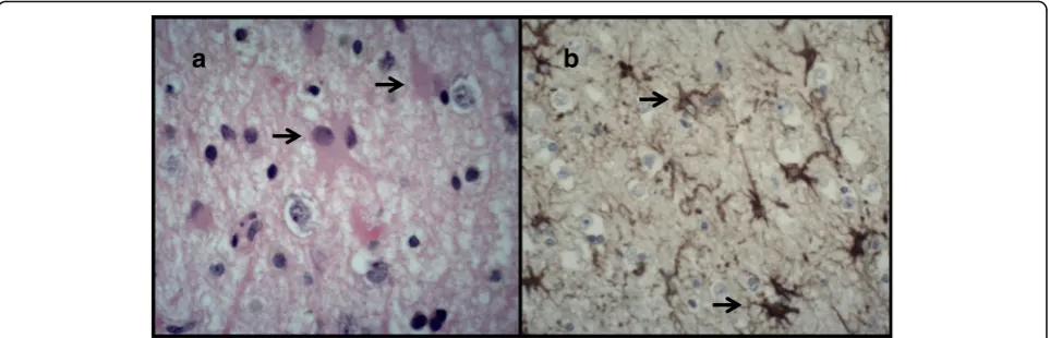 Fig. 2 Astrocytic gliosis. (a) H&E and (b) glial fibrillary acid protein (GFAP) stained sections demonstrate marked astrocytic gliosis characterised byan evenly dispersed proliferation of large reactive astrocytes with abundant eosinophilic cytoplasm and branching processes (arrows)