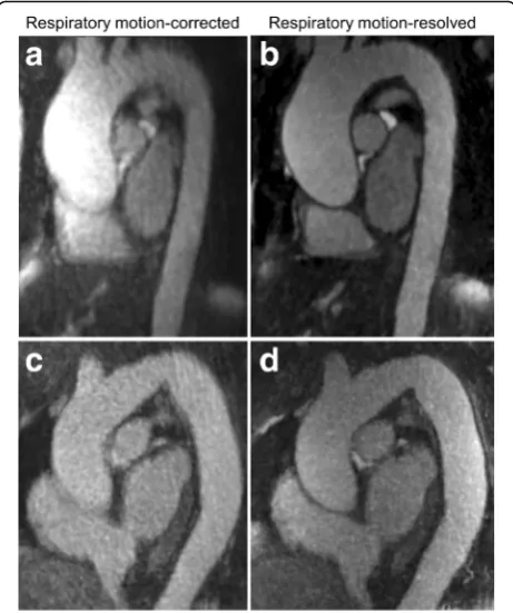 Fig. 2 Representative motion-corrected (a, c) and motion-resolved(b, d) images from a 74-year-old woman (a, b) and a 59-year-oldwoman (c, d), both with ascending aorta dilation