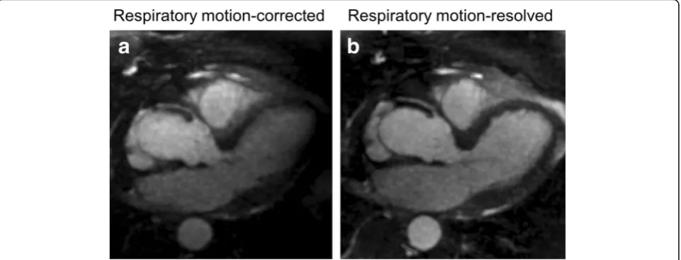 Fig. 3 Left ventricular outflow track view of the heart visualizing the proximal segment of the right coronary artery