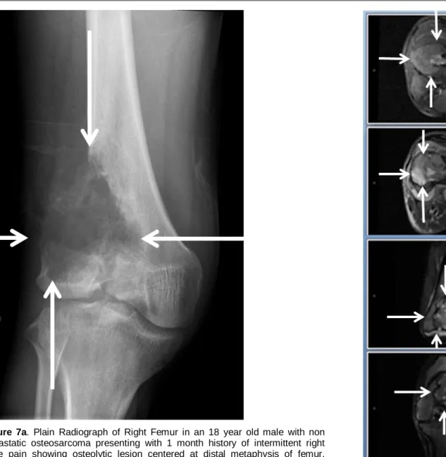 Figure 7a. Plain Radiograph of Right  Femur in an 18 year old male with non  metastatic osteosarcoma presenting with 1 month history  of intermittent right  knee pain showing osteolytic lesion centered at distal metaphysis of femur