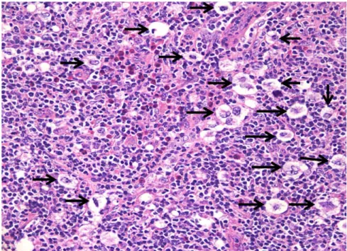 Figure 5b.  Incisional  Lymph  Node  Biopsy of neck shows lacunar cells (Reed- (Reed-Sternberg cell variant caused by cytoplasmic shrinking during formalin fixation)  consistent with a diagnosis of nodular sclerosing HD in same patient