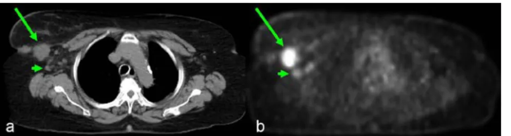 Figure  20  a,b.  PET/CT.  (a)  CT  has  high  spatial  resolution  for  identification  of  anatomic  structures  while  (b)  PET  shows  areas  of  increased  metabolic  activity