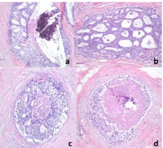 Figure 4 a,b,c,d.  Lobular  Carcinoma.  (a)  The  malignant  cells  lack  any  ductal  formation,  but  instead  line  up  in  a  row  like  a  string  of  pearls  (10x)