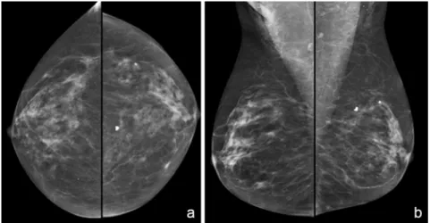 Figure 7 a,b.  Screening  Mammogram.  Standard  mammographic  views  are  the  following  (a)  Craniocaudal  (CC)  View  and  (b)  Mediolateral  Oblique  (MLO)  View