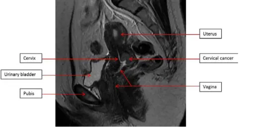 Figure 11. 41-year-old female patient with biopsy proven cervical cancer. A  sagittal image from an MRI of the pelvis demonstrates an endophytic lesion  involving  the  posterior  aspect  of  the  cervix,  consistent  with  the  biopsy  proven cervical can