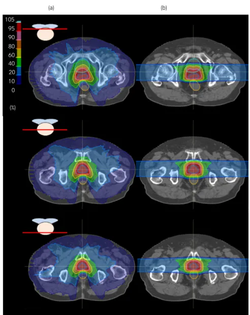 Fig. 2 Comparison of dose distribution between volumetric-modulated arc therapy and PBT