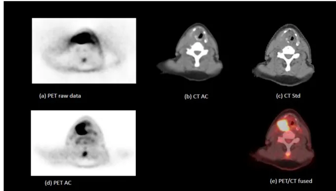 Figure  1.4.2.3.  Example  of  PET/CT  acquisition-reconstruction-fusion  for  a  patient  with  cancer  of  right  pyriform  fossa