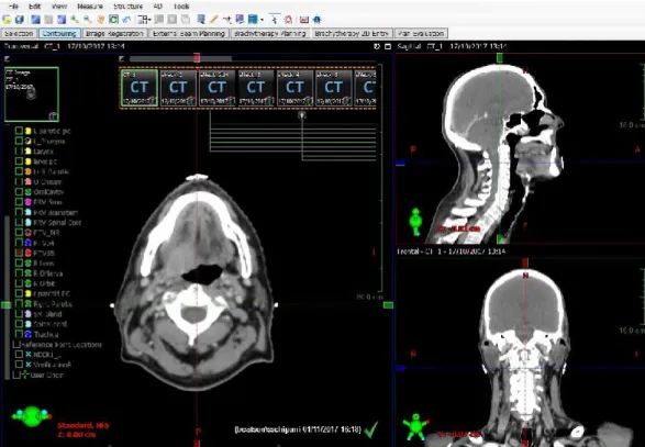 Figure  2.7.2.  Contrast  enhanced  simulation  CT  of  the  head&amp;neck  region  imported in the radiotherapy treatment planning system (Eclipse, Varian) 