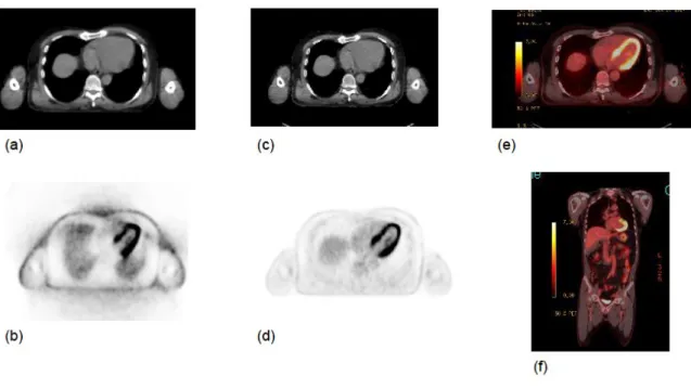 Figure 2.7.3. Body PET/CT from the base of the neck to mid thighs. Raw PET (b) was  corrected with CT for attenuation-correction (a)