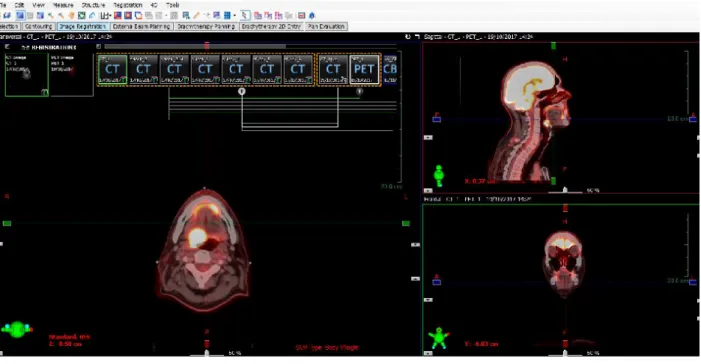 Figure  2.9.1  Image  fusion.  Simulation  CT  and  H&amp;N  PET/CT  were  fused  using  the  Eclipse  (Varian) automatic 6-freedom-degree rigid fusion algorithm (a,b)