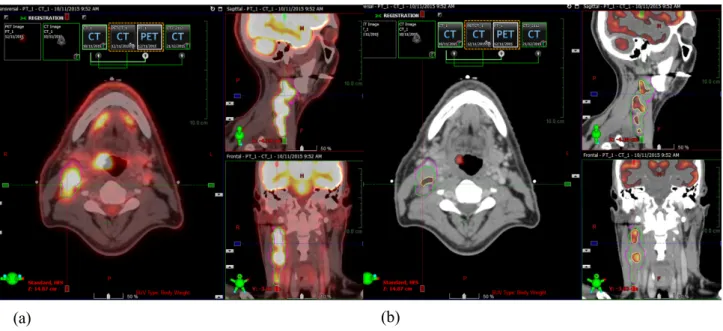 Figure 2.11.2 Patient with bulky N3 disease in the right neck. (a) Nodal tumour defined on CTsim  (magenta), PET/CT with visual assessment (green) and (b) 50% threshold of SUVmax (yellow)  are shown